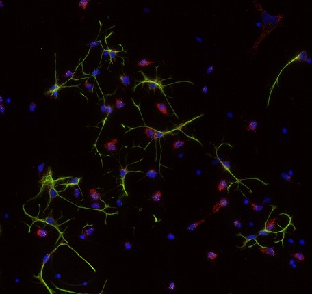 Tumorzellen (grün) umhüllen in einer Zellkultur Neuronen (rot),
Zellkerne (blau). 
Bild: Universitätsmedizin Göttingen